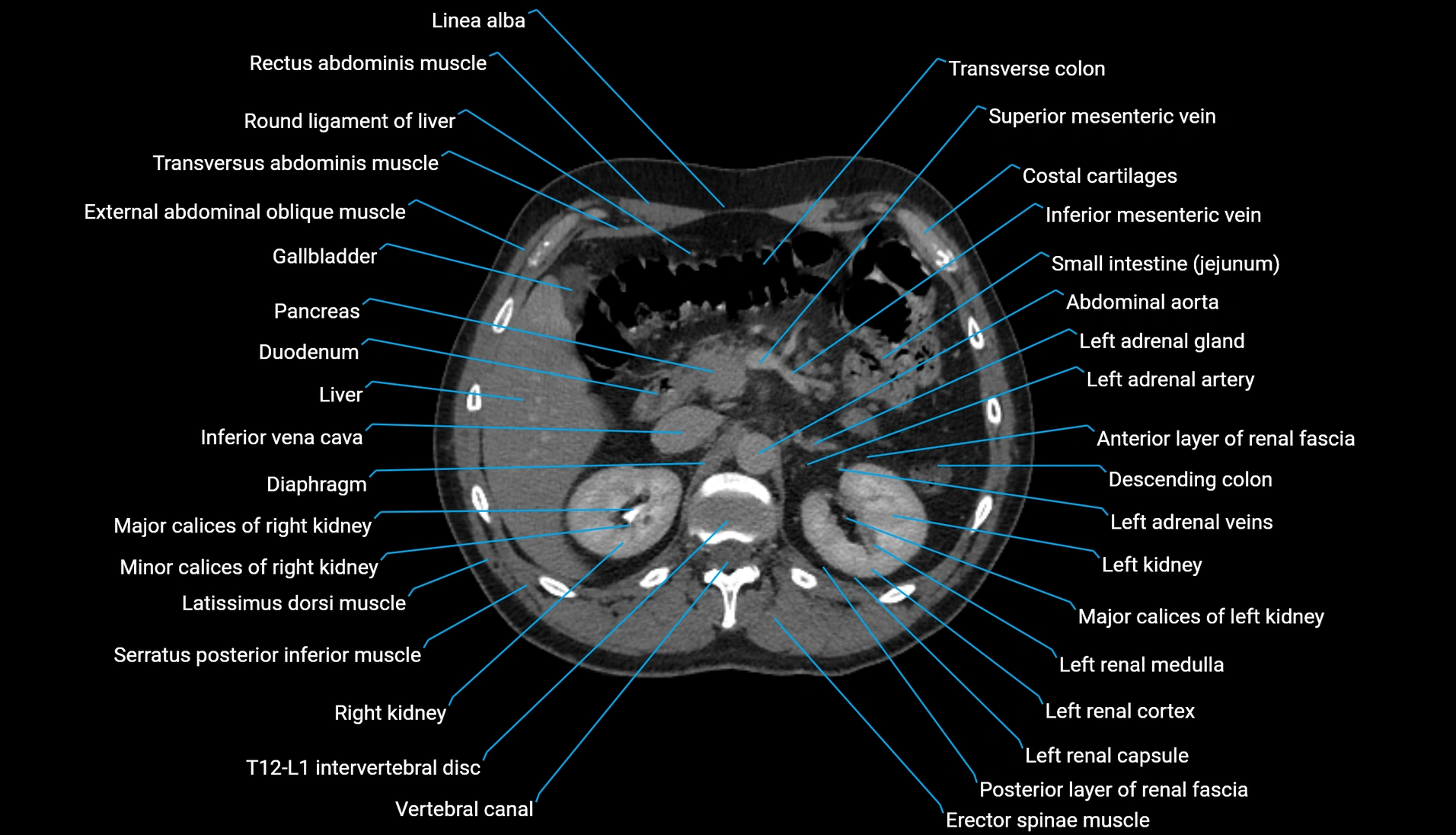 CT urogram axial cross sectional anatomy  labelled radiology image-00088.webp